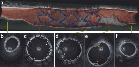 Изображение протезированной коронарной артерии у свиньи, полученное в ходе исследования с помощью OFDI. Крестиками отмечены отложения на внутренней поверхности сосуда (иллюстрация и фото Seok H. Yun et al.).