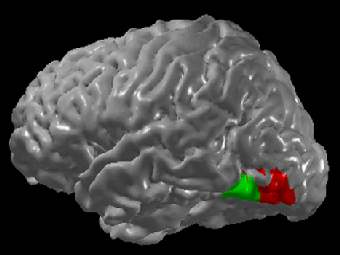 Область мозга, предположительно активизирующаяся при графемно-цветовой синестезии. Изображение Wikipedia Commons.
