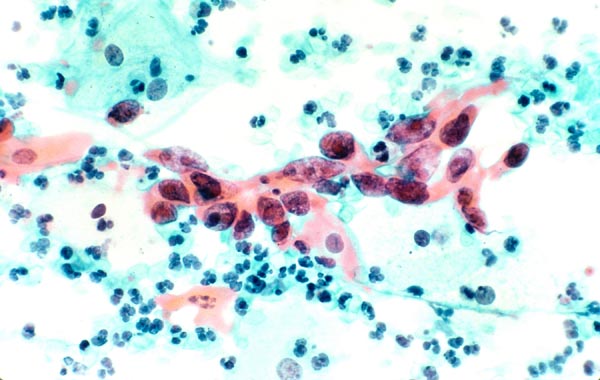 Так выглядит цервикальный рак (рак шейки матки) под микроскопом. Регулярные медицинские обследования позволяют обнаружить предраковые изменения шейки матки, которые затрагивают лишь поверхностный слой шейки и весьма эффективно лечатся. Фото: National Cancer Institute/NIH.