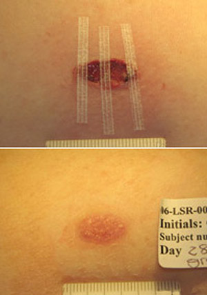 Можно отрезать лоскут искусственной кожи по размеру раны и закрепить его с помощью стерильных пластырей (вверху), через четыре недели пластыри или повязка удаляются (внизу) (фото Intercytex).